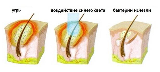 svetoterapiya